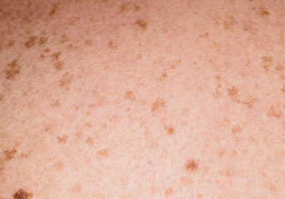 You will never guess what causes dark spots on your skin…
